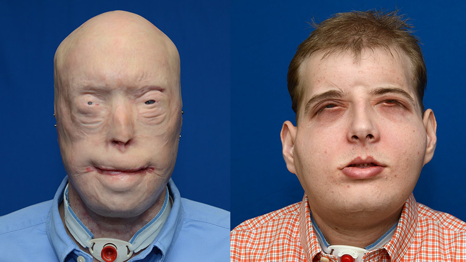 Disfigured Firefighter Receives Most Extensive Face Transplant to Date at  NYU Medical Center | KTLA