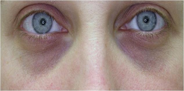 dark-under-eye-circles2.jpg
