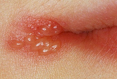 dermnet_rf_photo_of_cold_sore_blisters.jpg