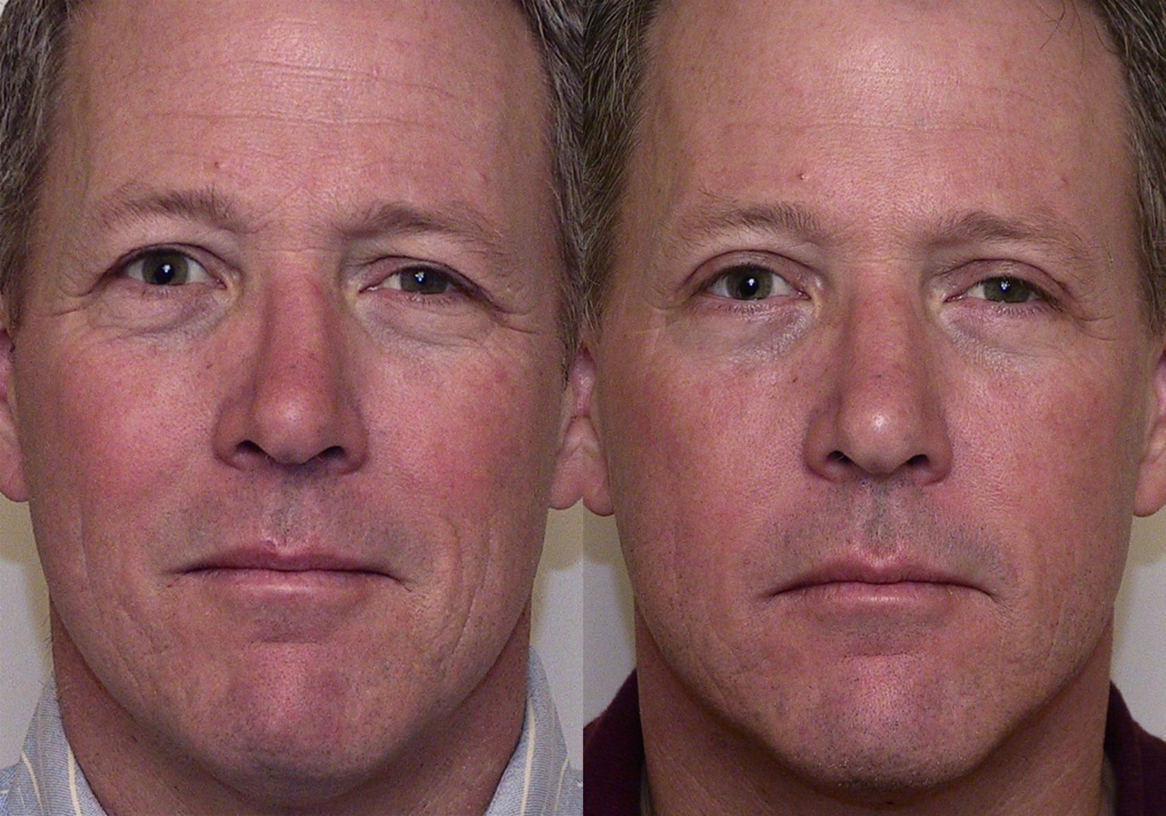 Eyelid Surgery in Atlanta | Buckhead Facial Plastic Surgery