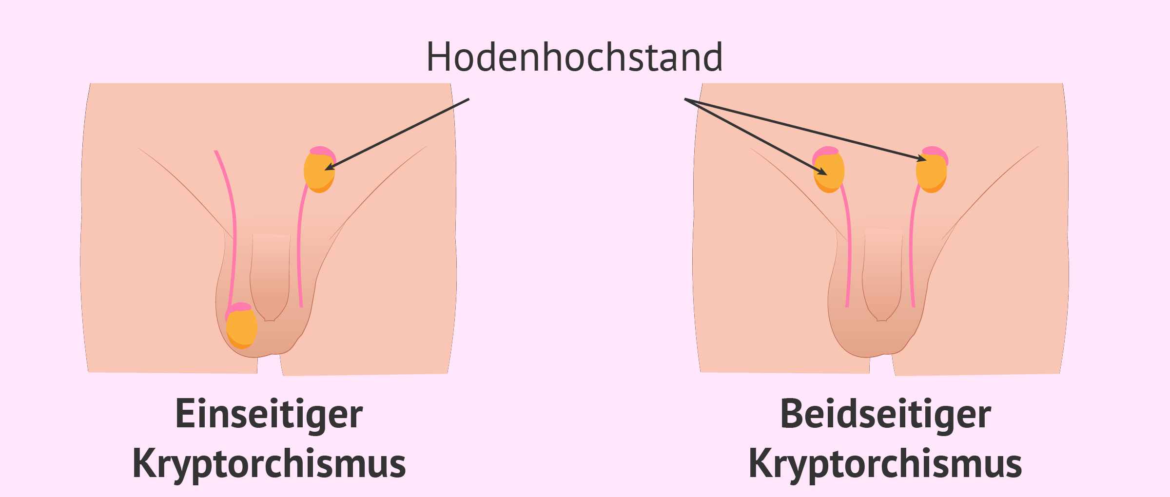 einseitiger-und-zweiseiter-kryptorchismus.png