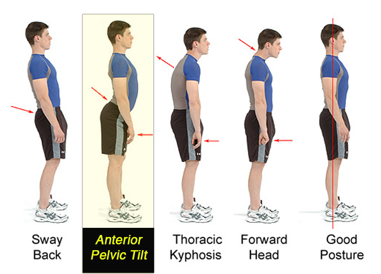 Anterior%2BPelvic%2BTilt%2BGuide%2Band%2BTreatment.jpg