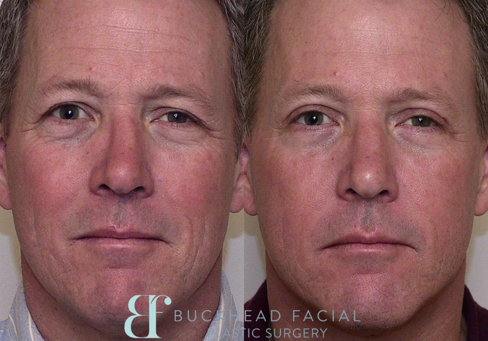 Eyelid Surgery in Atlanta | Buckhead Facial Plastic Surgery
