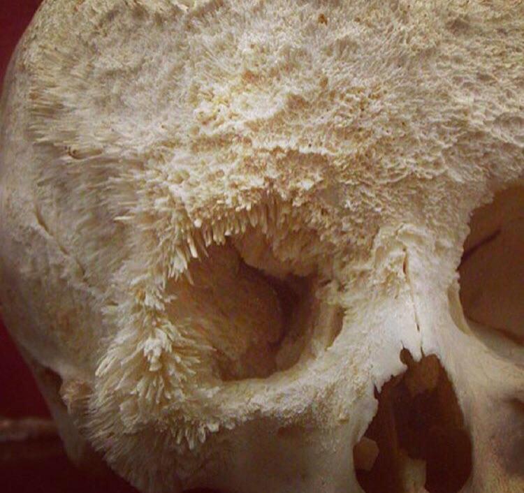 This is what bone cancer looks like : r/pics