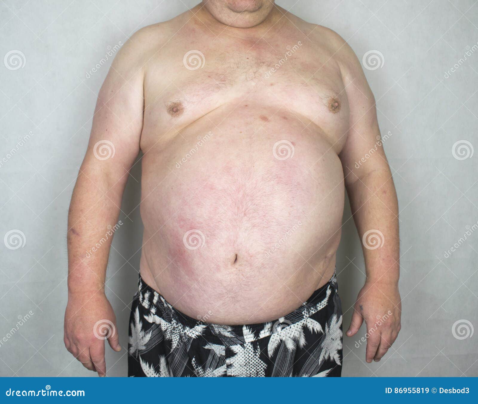 obesity-obese-man-photo-isolated-86955819.jpg