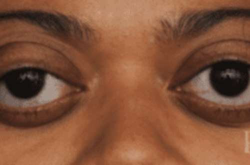 116202050636-23041q5ddx-bulging-eye-3.png