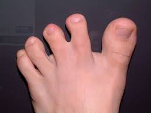 Houston's Top Podiatrist, Dr. Sherman Nagler on the Causes of Webbed Toes?  – Foot Houston