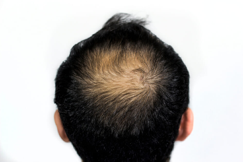 Male-baldness.jpg