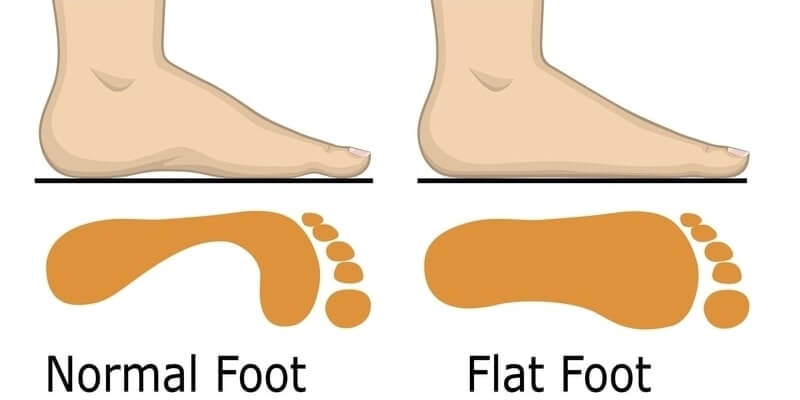 Flat Feet: Symptoms, Causes, Treatment & More - The Orthopedic Clinic