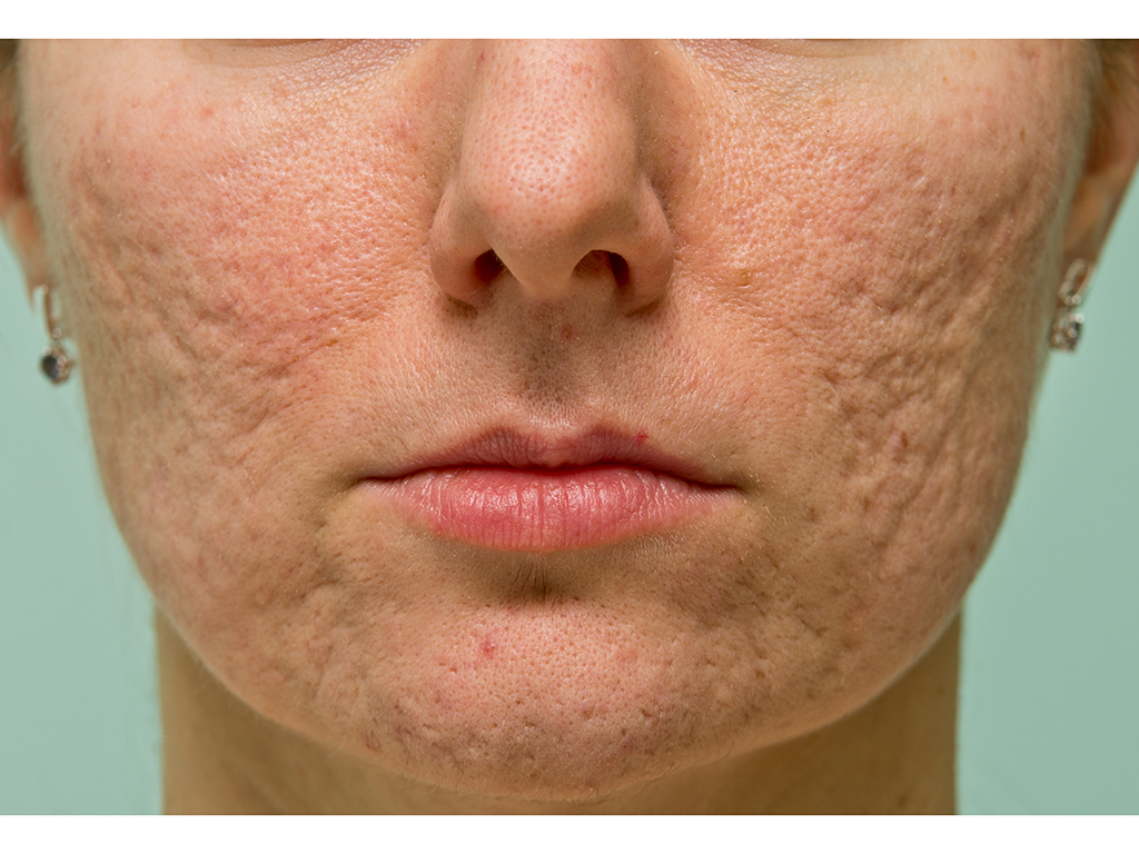 acne-scars.jpg