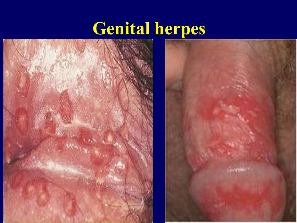 Genital+herpes.jpg