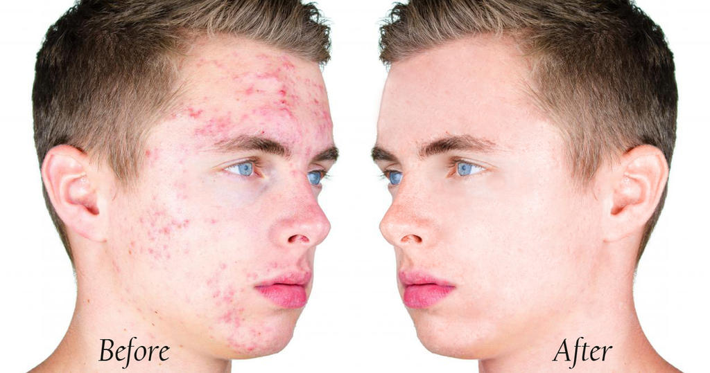 before_and_after_acne_boy_by_lupuswynnejones-d90hxx0.jpg