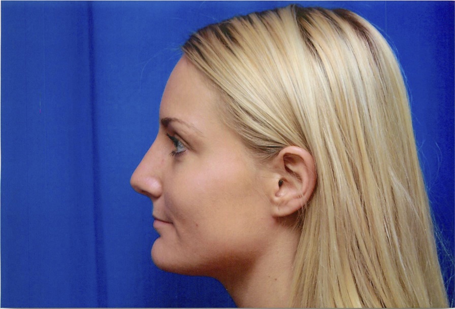 4-Profile-After.jpg