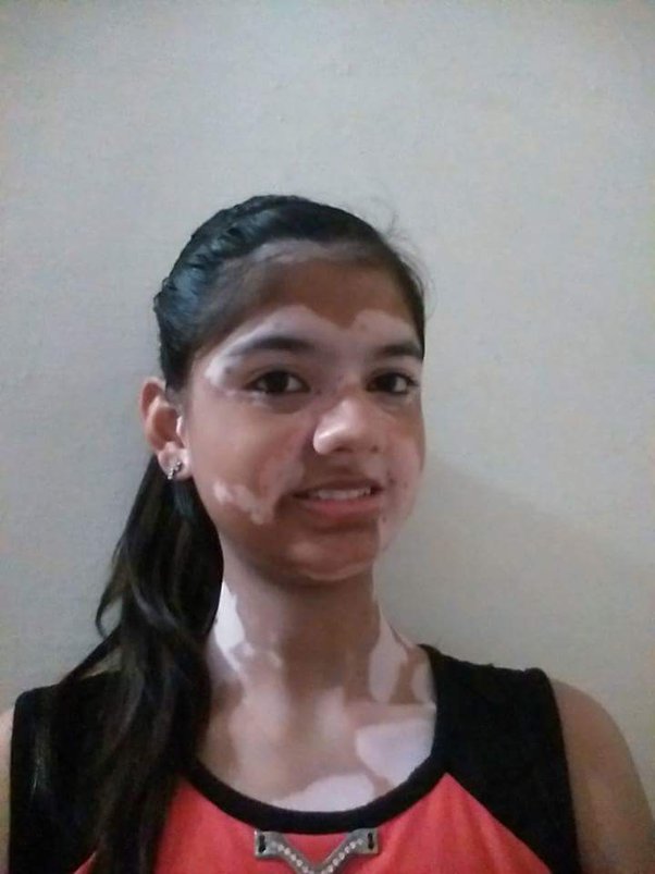My daughter is suffering from vitiligo, now her white patches are turning  pink. What does it indicate? - Quora