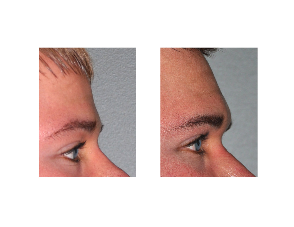 Brow-Bone-Implant-result-side-Dr-Barry-Eppley-Indianapolis.jpg