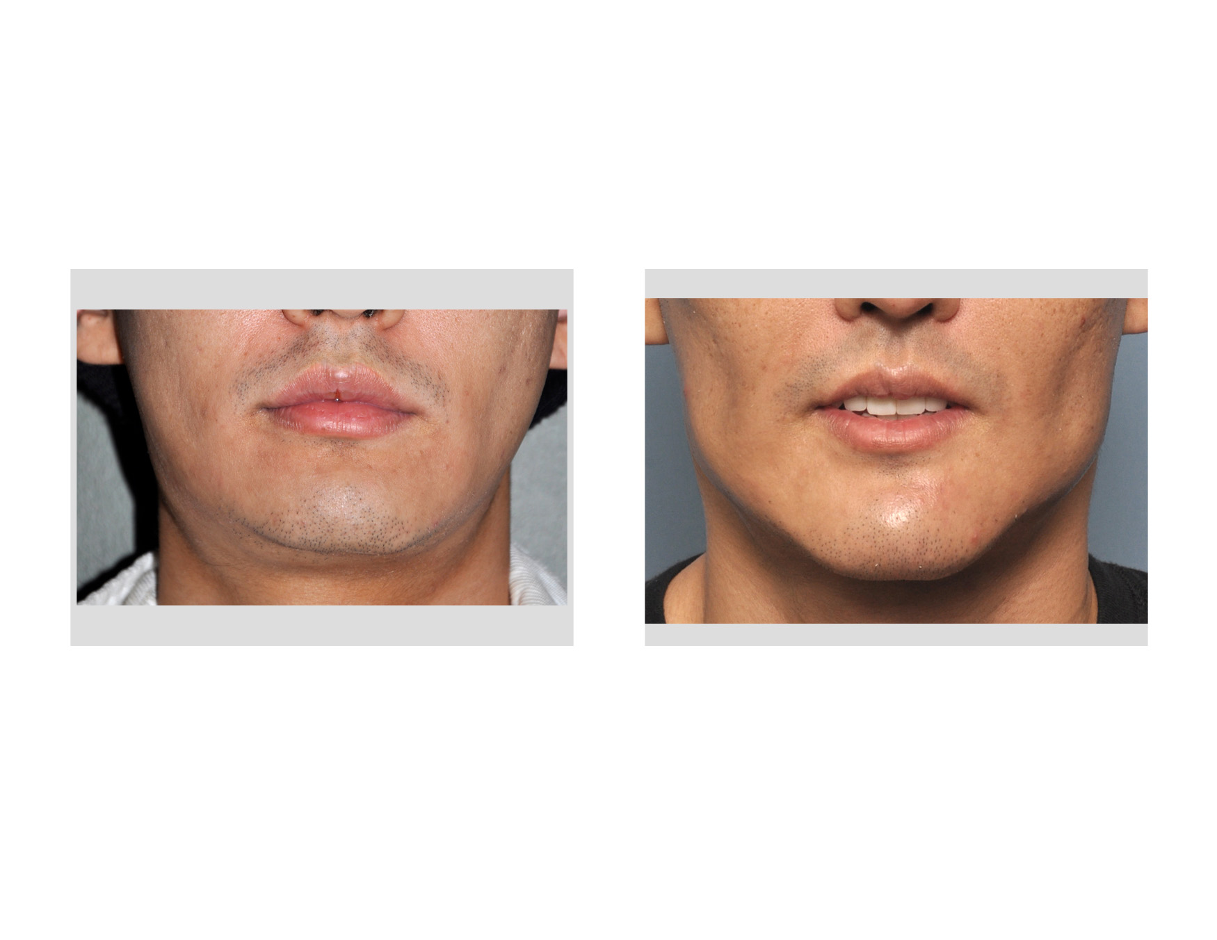 Custom-Jawline-Implant-result-frofnt-view-Dr-Barry-Eppley-Indianapolis.jpg