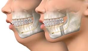 Orthognathic Surgery - Orthodontic Services
