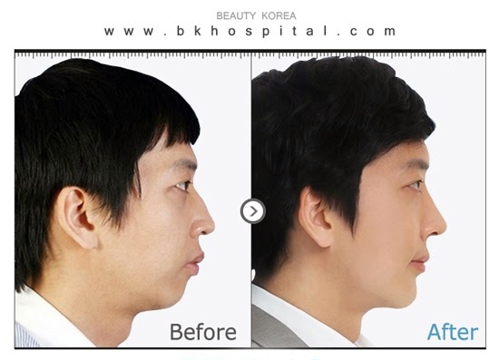 Eyelid Surgery Legend Dr. Kim Byung Gun: [BK Plastic Surgery Hospital ...
