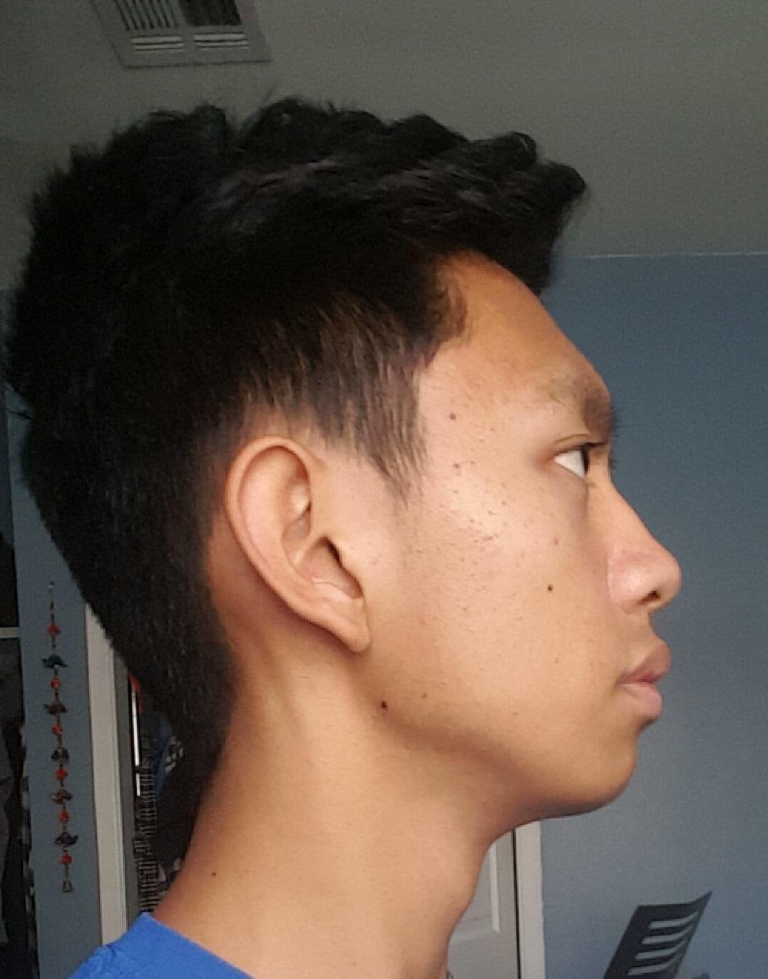 Is my weak chin/jaw really noticeable? [17 M] : amiugly