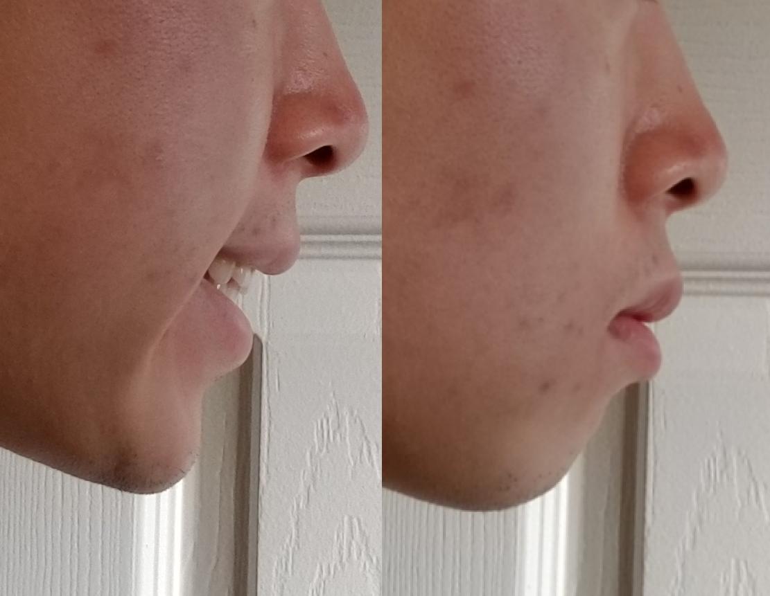 Can mewing fix my receded chin? : orthotropics