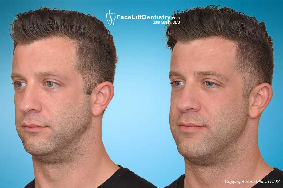 How To Fix Receding Chin - People who decide to have a gender ...