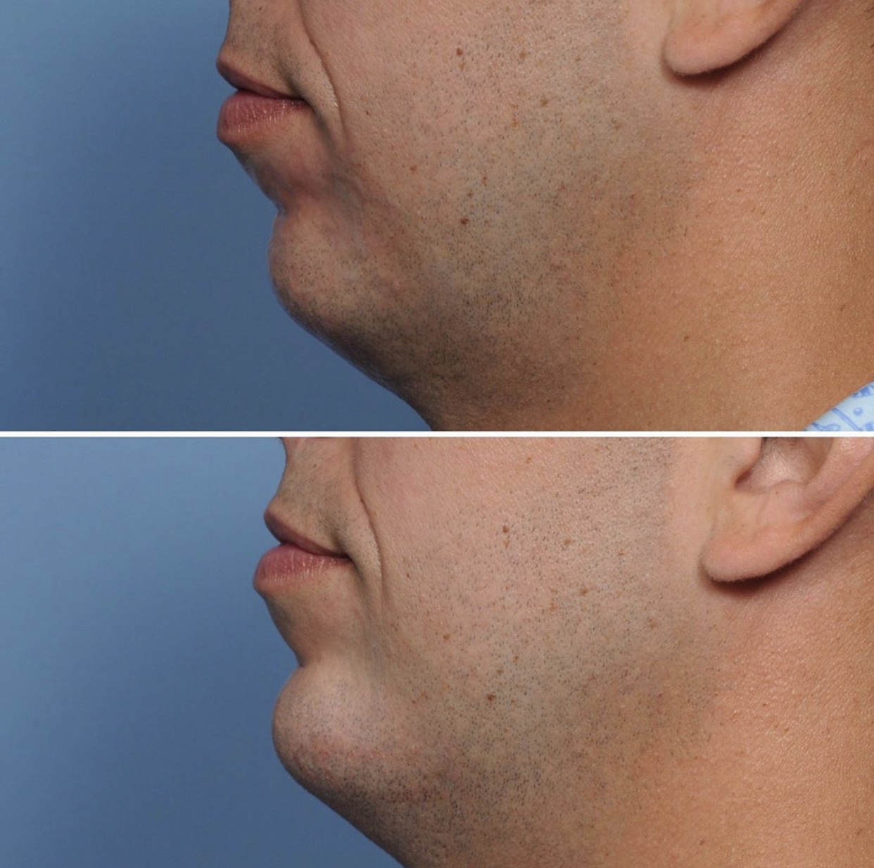 Nonsurgical Chin Augmentation