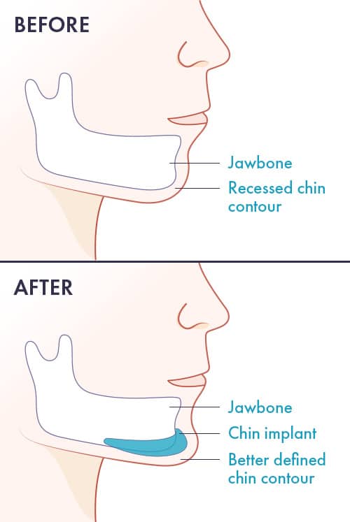 Chin surgery | Genioplasty | Types | Cost | Recovery - Sutured