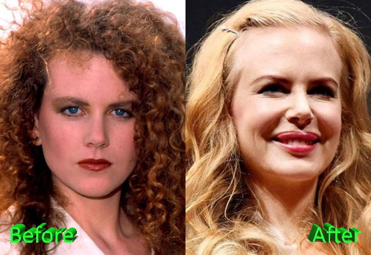 Nicole Kidman plastic surgery | Cirugía plástica famosos, Nicole ...