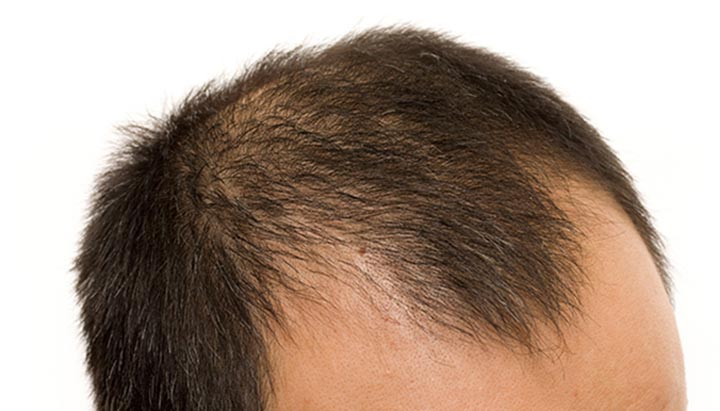24515-male-pattern-baldness