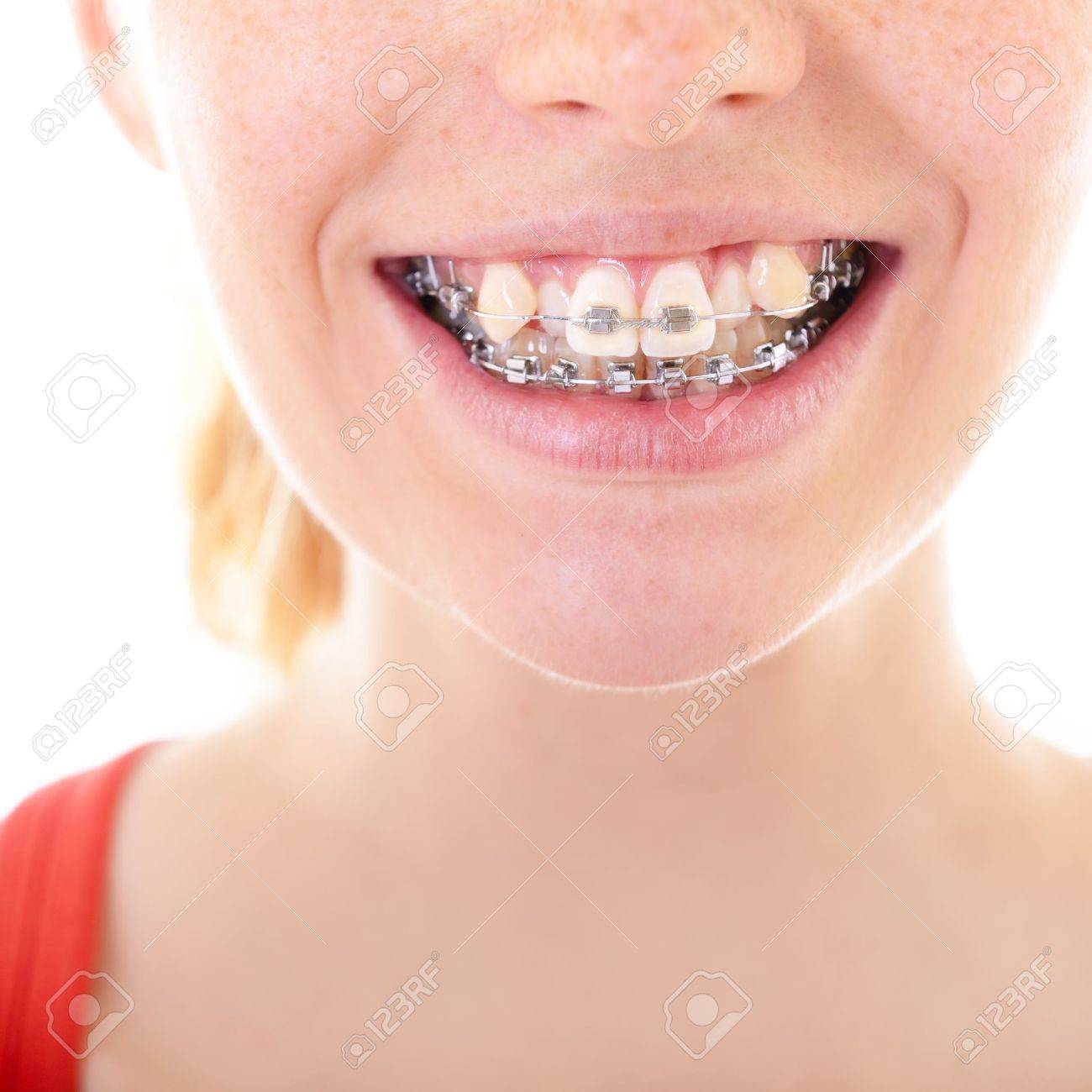 21994390-teeth-with-braces-female-mouth-with-brackets-closeup.jpg