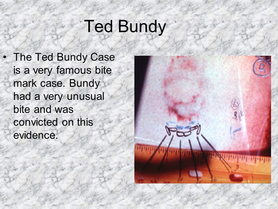 Ted+Bundy+The+Ted+Bundy+Case+is+a+very+famous+bite+mark+case..jpg
