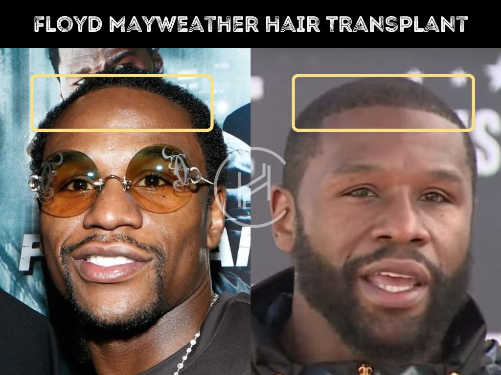 Before-and-after-Floyd-Mayweather-hair-transplant-photo.jpg